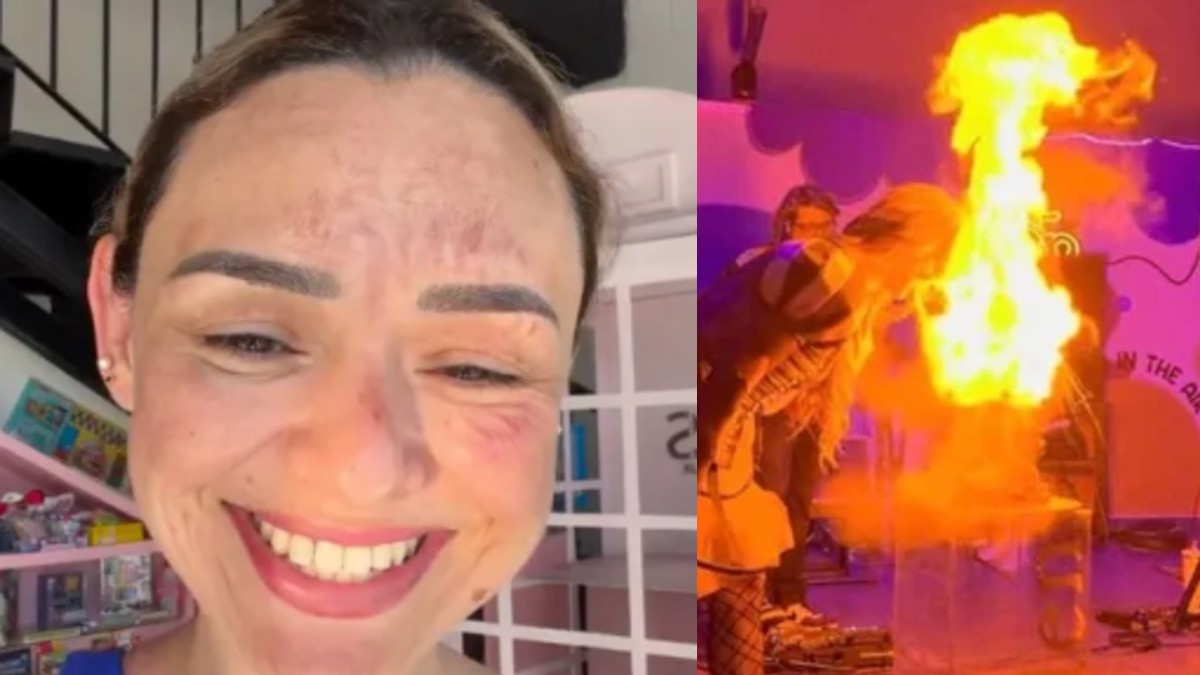 Arlen Hernández: Influencer sufre quemadura facial por ‘pastel explosivo’